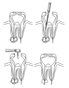 Don't Believe These Root Canal Myths | Summit Dental Care